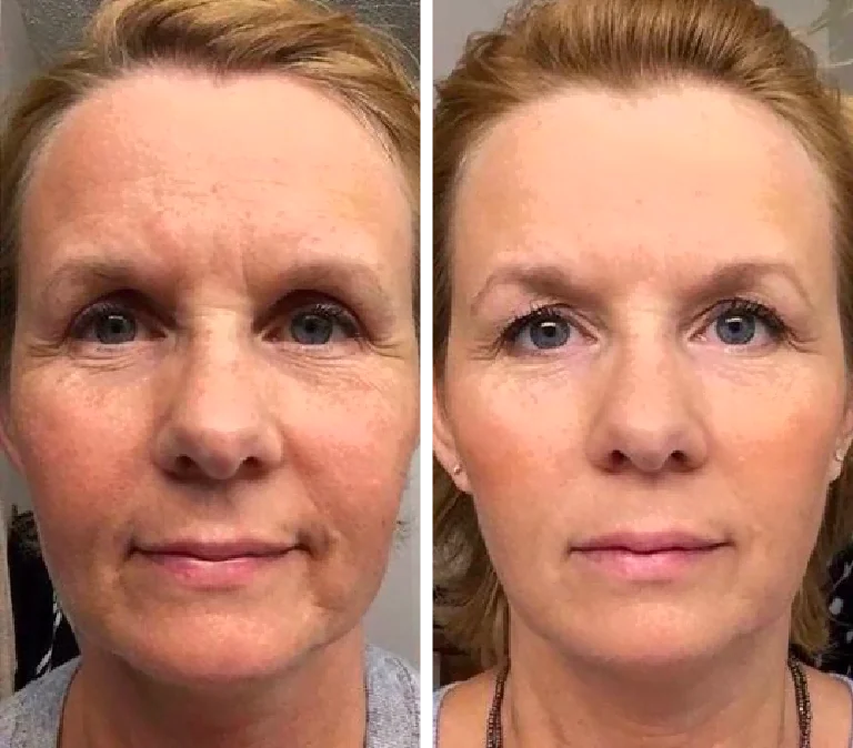 Before and After Photo: Jade face roller luminous complexion