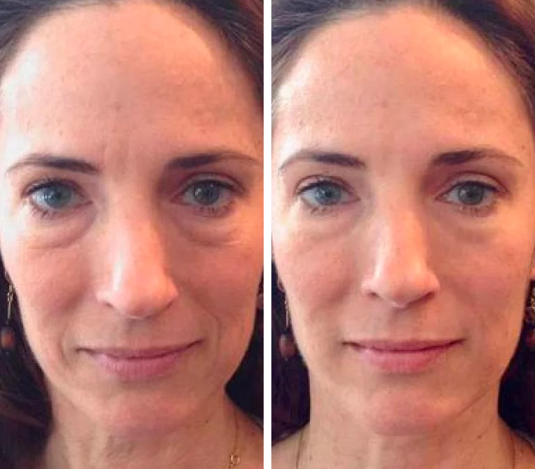 Before and After Photo Roller under the eyes