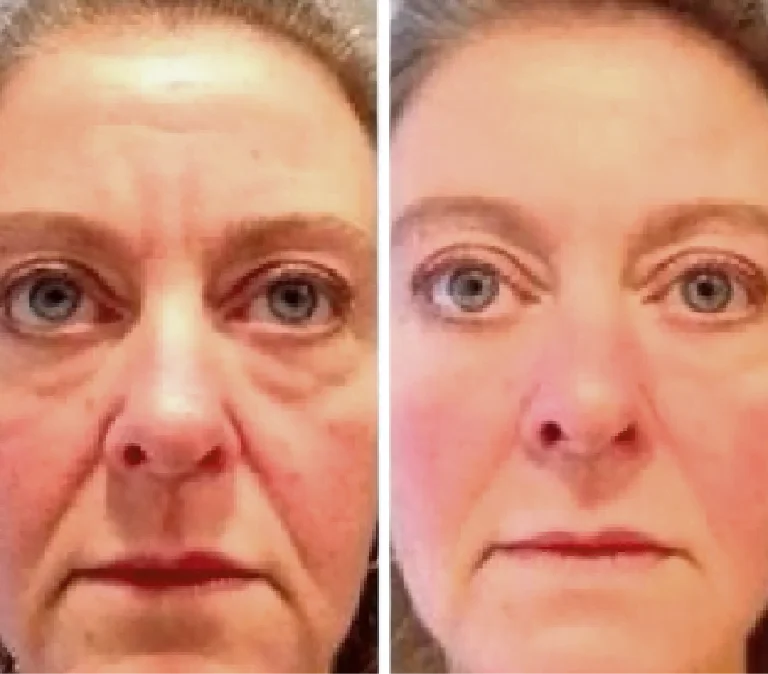 Before and After Photo: Roller for lines and dark circles