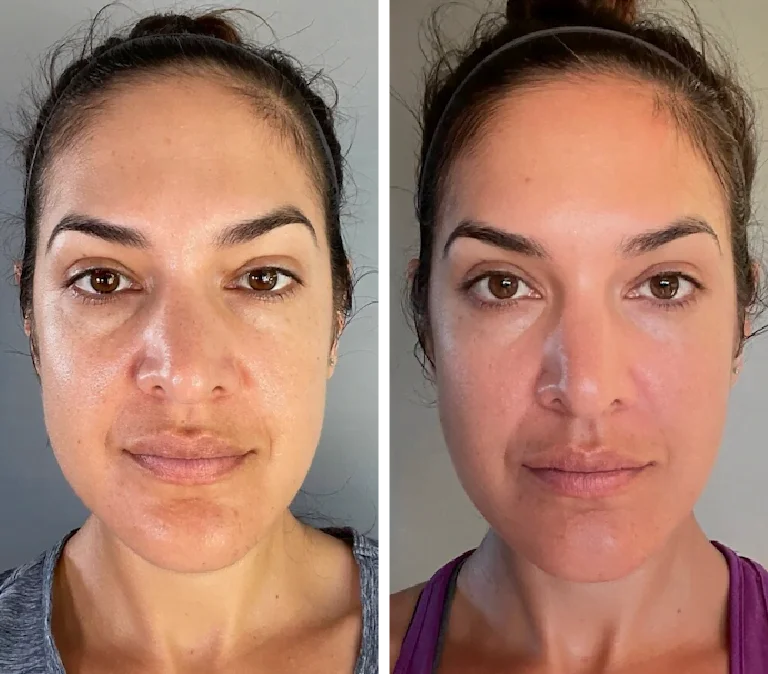 Before and After Photo of Oval Face Gua Sha