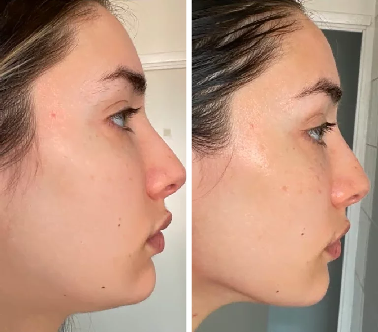 Before and After Photo Gua Sha Jowline