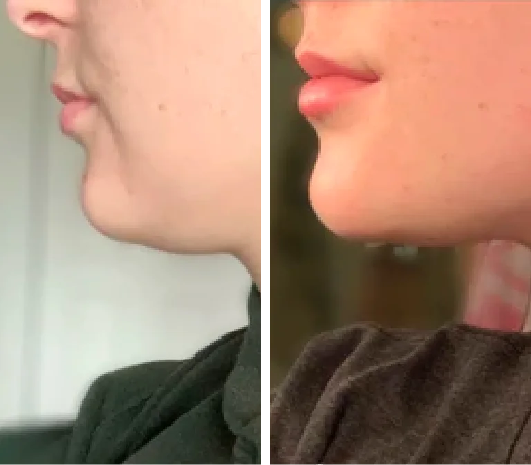 Before and After Photo Gua Sha double chin