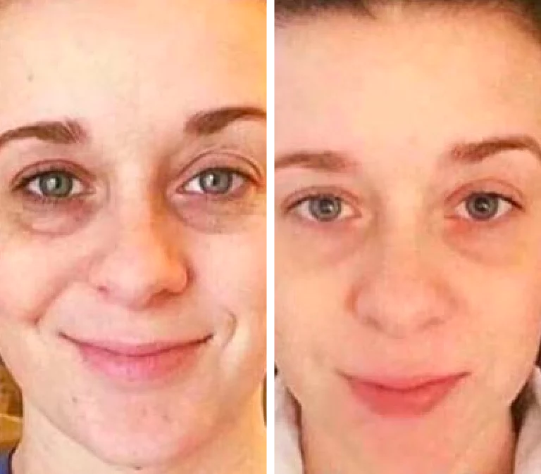 Before and After Photo: Jade face roller dark circles
