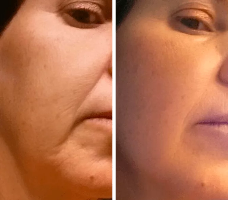 Before and After Photo Gua Sha nasolabial fold