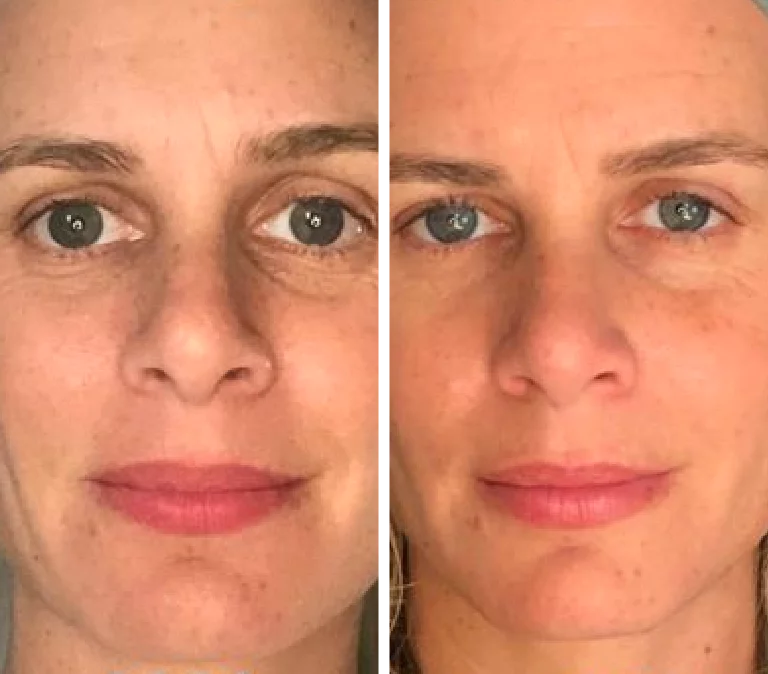Before and After Photo: Roller dark circles